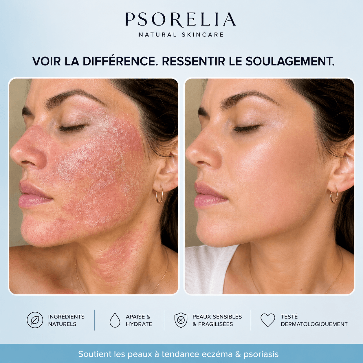 Psorelia - Baume réparateur pour l’eczéma et le psoriasis