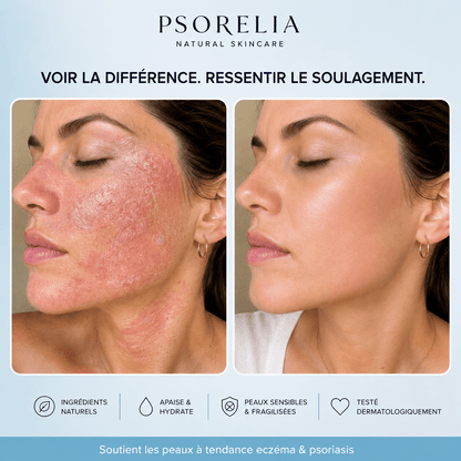 Psorelia - Baume réparateur pour l’eczéma et le psoriasis