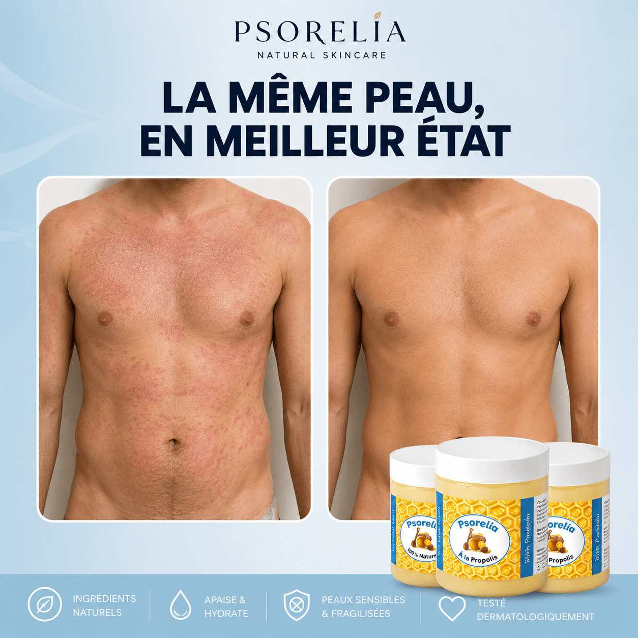 Psorelia - Baume réparateur pour l’eczéma et le psoriasis