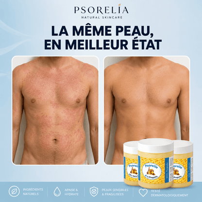 Psorelia - Baume réparateur pour l’eczéma et le psoriasis