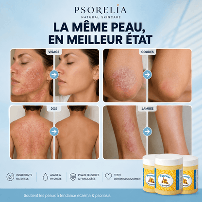 Psorelia - Baume réparateur pour l’eczéma et le psoriasis